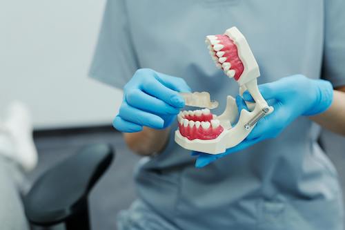 A person holding a teeth model to demonstrate dental transformation procedure