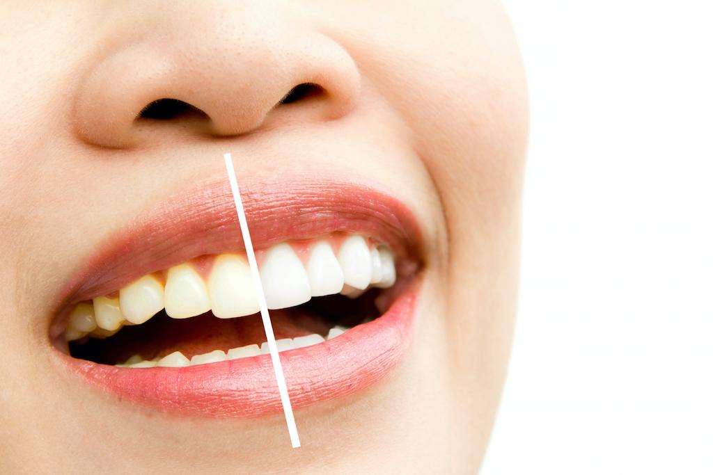 A before and after photo of a woman's teeth showing discoloration and whitening effects
